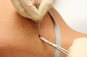 Laser Treatments